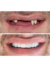 Porcelain Crown - Neta Dental Clinic