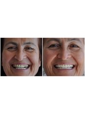 Veneers - Dental Smile Antalya