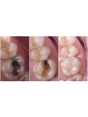 Inlay or Onlay - Dental Smile Antalya
