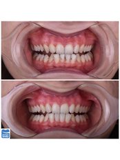 Teeth Cleaning - Dental Smile Antalya