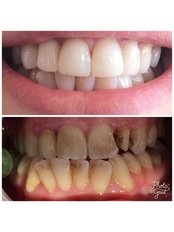 Zirconia Crown - Dental Smile Antalya