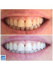 Home Whitening Kits - Dental Smile Antalya