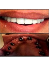 Dental Implants - Akva Dental Clinic