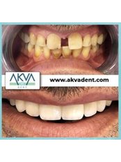 DSD - Digital Smile Design - Akva Dental Clinic