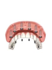 All-on-6 Dental Implants - Akva Dental Clinic