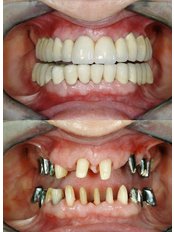Dental Implants - DentHealth Clinic