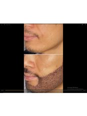 Beard Transplant - Dose Group