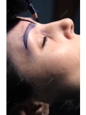 Eyebrow Transplant - Dose Group
