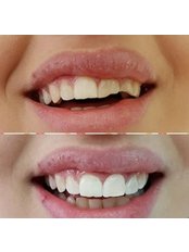 Fillings - Isdent Implantology Clinic