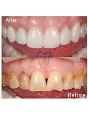 Zirconia Crown - Platinum Ağız Ve Diş Sağlığı Polikliniği (Platinum Dental Clinics)