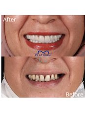 Zirconia Crown - Platinum Ağız Ve Diş Sağlığı Polikliniği (Platinum Dental Clinics)