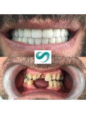 Dental Implants - Saluss Medical Group- Istanbul