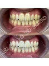 Laser Teeth Whitening - 360 Dental and Maxillofacial Center