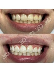 Laser Teeth Whitening - 360 Dental and Maxillofacial Center