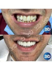 Porcelain Crown - 360 Dental and Maxillofacial Center