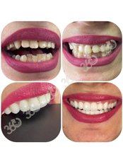 Zirconia Crown - 360 Dental and Maxillofacial Center