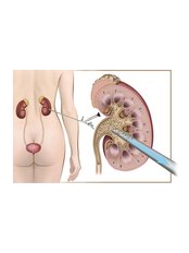 Kidney Stones Removal - Aqua Health