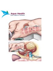 Nephrectomy - Aqua Health