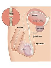 Vasectomy - Aqua Health