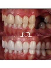 Dental Implants - Best Dental Istanbul