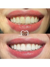 Teeth Whitening - Best Dental Istanbul