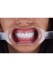 Dental Implants - Estesie Clinic
