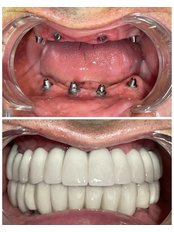 Dental Implants - Nuklinik