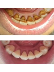 Teeth Cleaning - Nuklinik