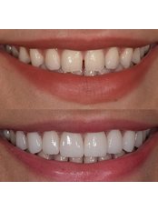 Veneers - Dentaliva Ağız ve Diş Sağlığı Polikliniği