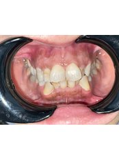 Veneers - Kayasehir Dental Clinic