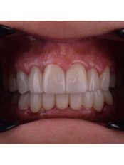 Veneers - Kayasehir Dental Clinic
