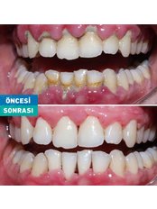 Teeth Cleaning - Polident Oral and Dental Health Clinic
