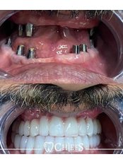 Dental Implants - Chiefs Dental