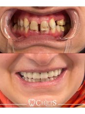 Hollywood Smile - Chiefs Dental