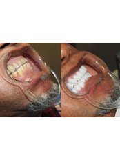 Zirconia Crown - Chiefs Dental