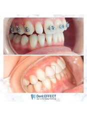 Composite Veneers - Dent EFFECT