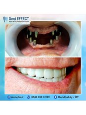 Dental Implants - Dent EFFECT