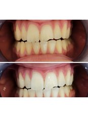 Teeth Whitening - Dentist Ozlem Ozcan