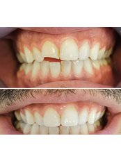 Dental Bonding - Dentist Ozlem Ozcan