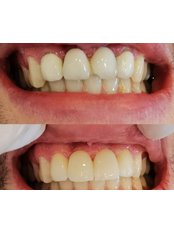 Dental Bridges - Dentist Ozlem Ozcan