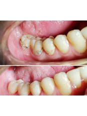 Fillings - Dentist Ozlem Ozcan