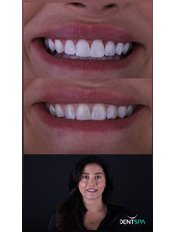 Dental Bonding - DentSpa