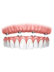 All-on-6 Dental Implants - DentSpa