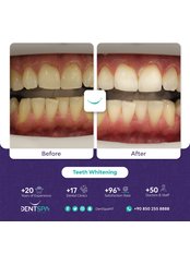 Teeth Cleaning - DentSpa