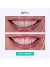 Teeth Whitening - DentSpa