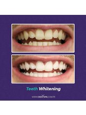 Teeth Whitening - DentSpa