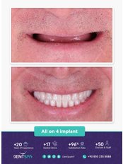 All-on-4 Dental Implants - DentSpa