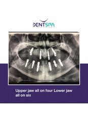 All-on-6 Dental Implants - DentSpa
