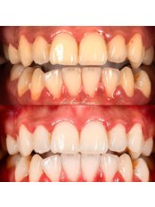 Teeth Whitening - Dr Birkan