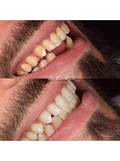 Dental Crowns - Dr Birkan